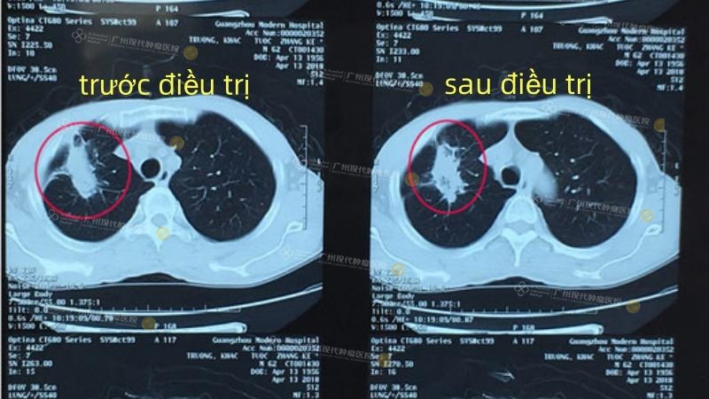 治疗后肿瘤缩小.jpg