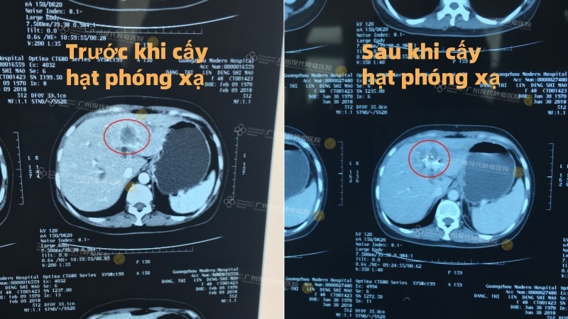 粒子植入前后肿瘤CT对比图_越南语.jpg