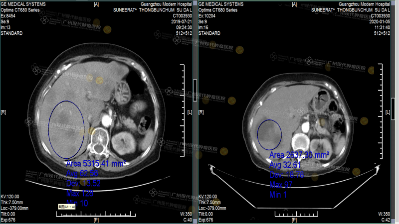 1-023141568.png 苏达丽肿瘤缩小_.png